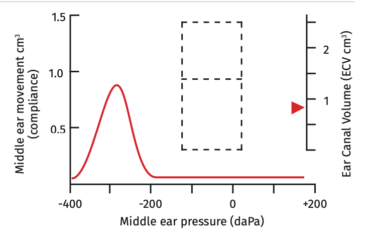 Tympanometry chart c